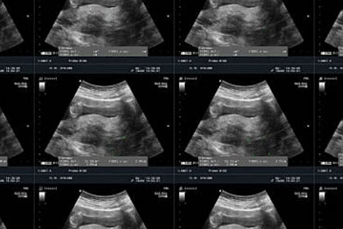 Ultrasonido transvaginal